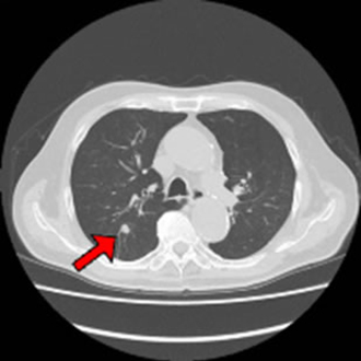 胸部CT（矢印：肺がん）