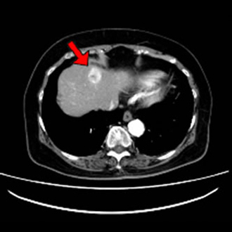 腹部造影CT（矢印：肝細胞がん）